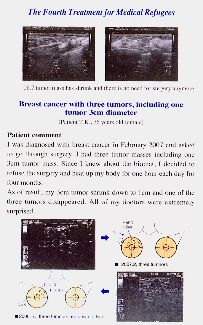 Cancer mass shrinks - Breast Cancer