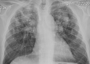 Harold Lung X-Ray